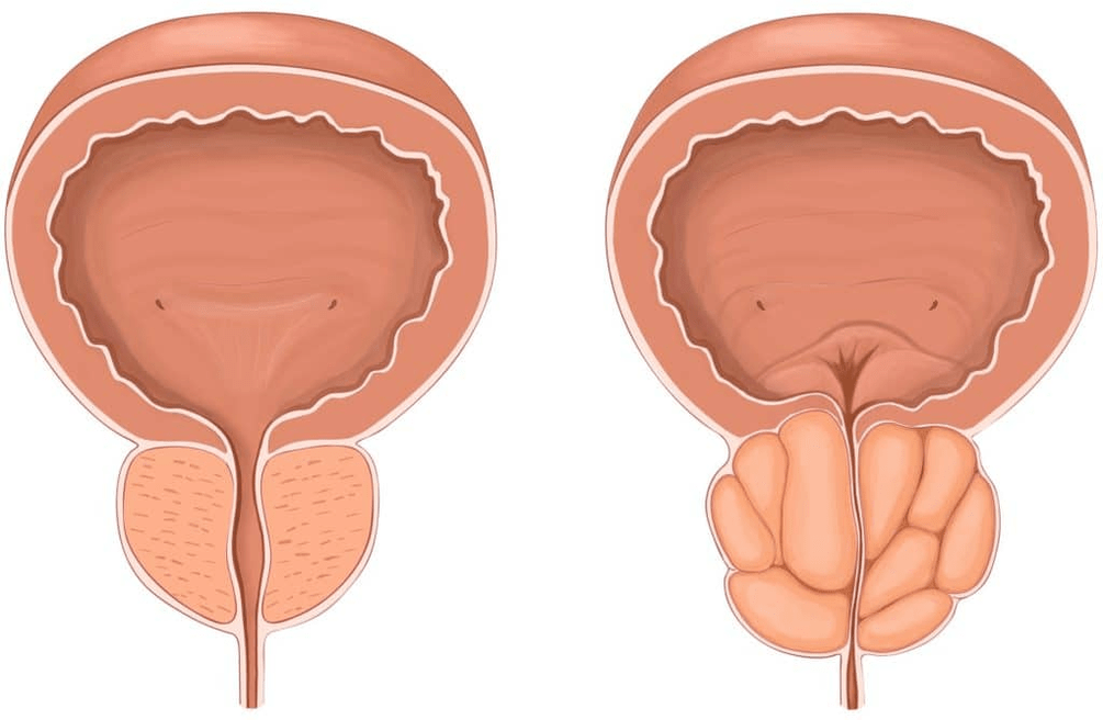 Prostatit sırasında prostata ne olur 