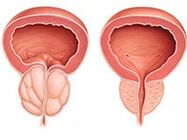 Prostatit