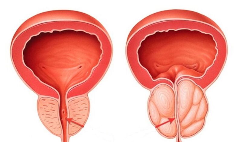Prostatit ile sağlıklı ve iltihaplı prostat